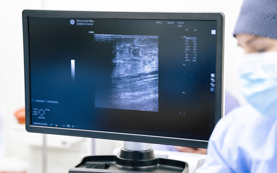 Leczenie żylaków metodą SVS