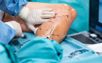 Leczenie żylaków metodą VenaSeal