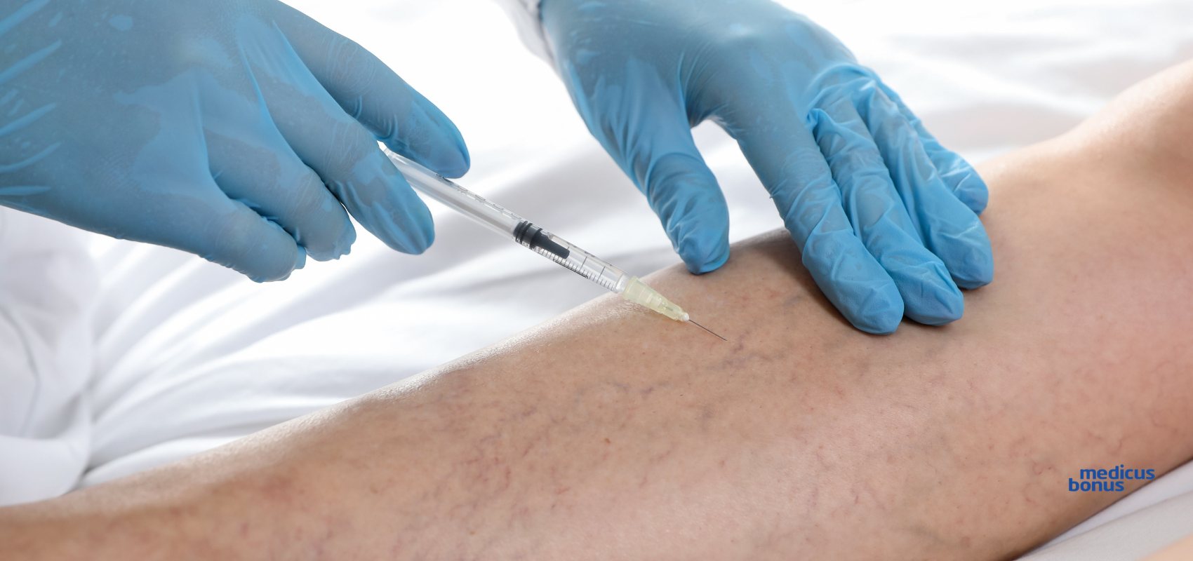 ostzrykiwanie żylaków