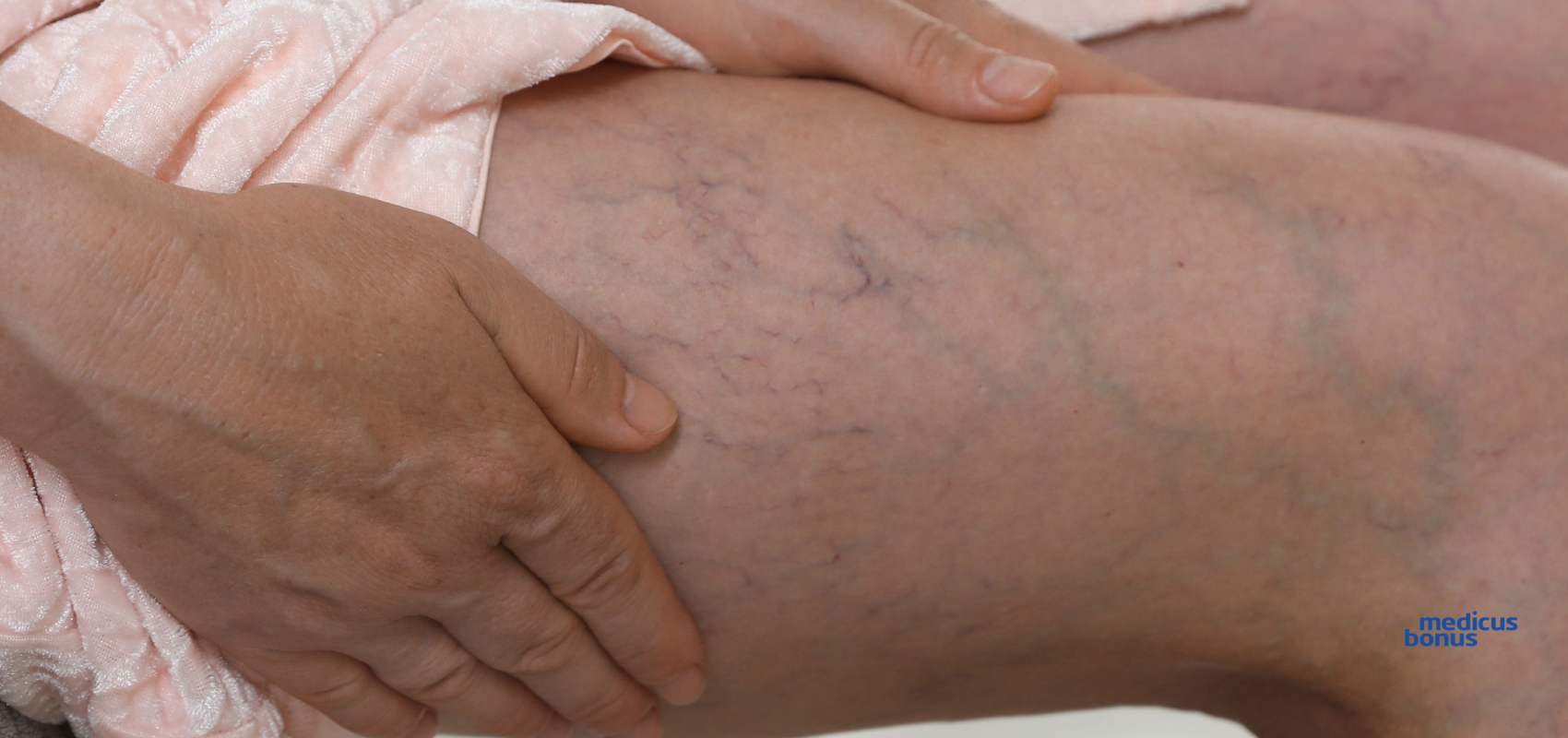 Leczenie żylaków metodą Venaseal