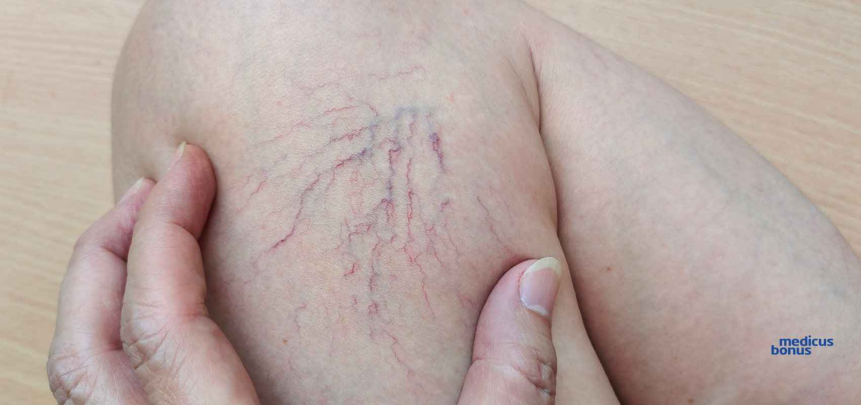 usuwanie pajączków na nogach