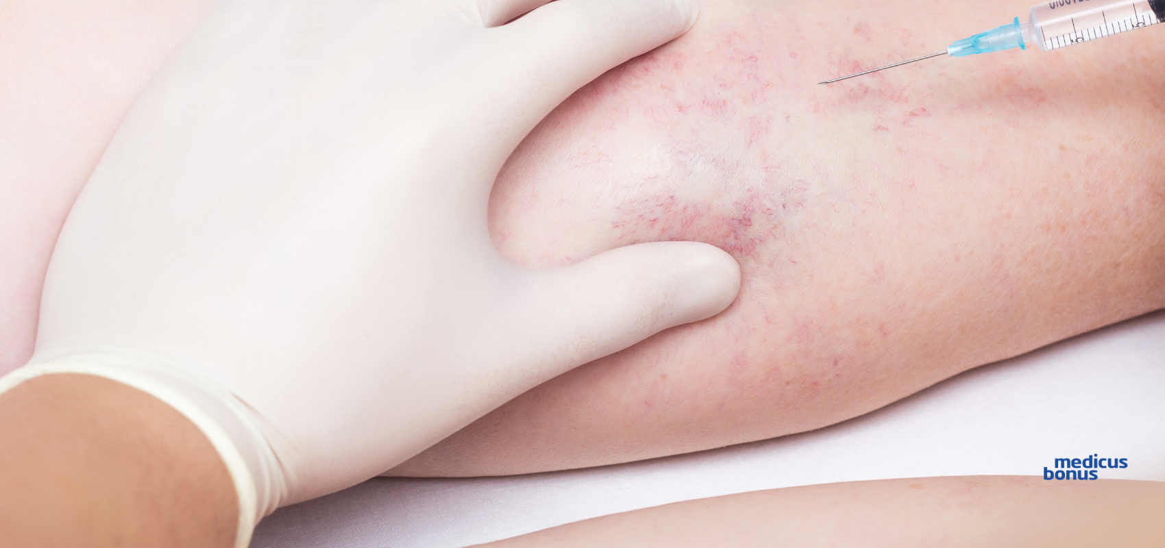 Skleroterapia Poznań